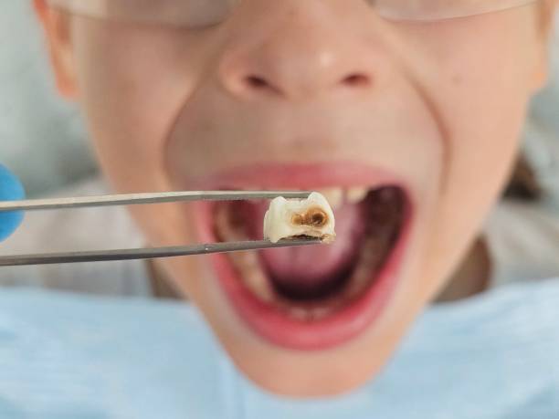 Best Emergency Tooth Extraction in Fulda, MN